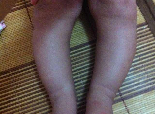 小朋友罗圈腿适合穿什么裤子