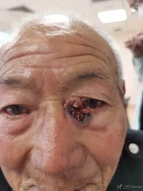 基底细胞癌诊疗