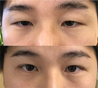 男士双眼皮整形案例对比