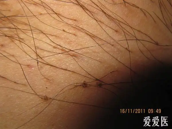 看图识病--------阴虱