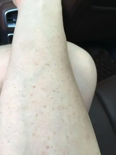 手臂上有很多毛细血管出血去医院抽血化验医生说我毛细血管脆弱然后让