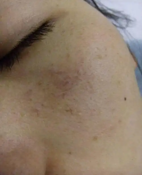 乙肝的症状肝病面容图片