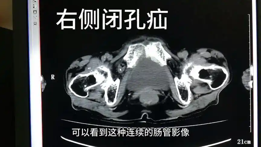 右侧闭孔疝并肠梗阻