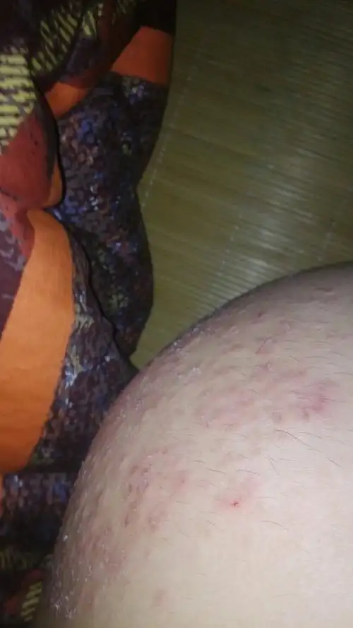 跟湿气有关吧,有水它就起疙瘩,有时就痒得很,不知道是什么,百度知道说