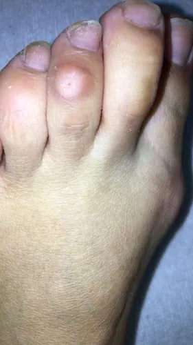 脚趾上长得是鸡眼还是骨刺呢?