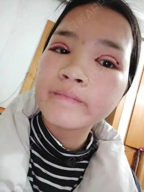 眼综合整形术后1天_开内眼角术后1天_全切双眼皮术后1天_眼型矫正术后