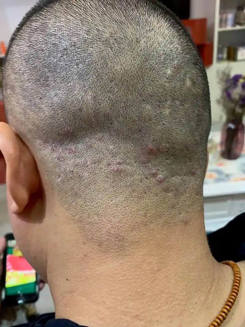 婺源同城热门推荐 #皮肤管理中心 男士头皮毛囊炎,你是不是 - 抖音