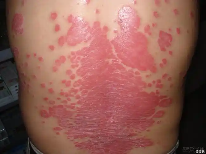 一例我无法治愈的红皮病