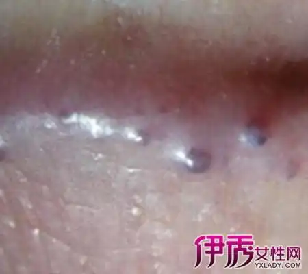 【图】假尖锐湿疣初期图片欣赏 4种方法教你预防