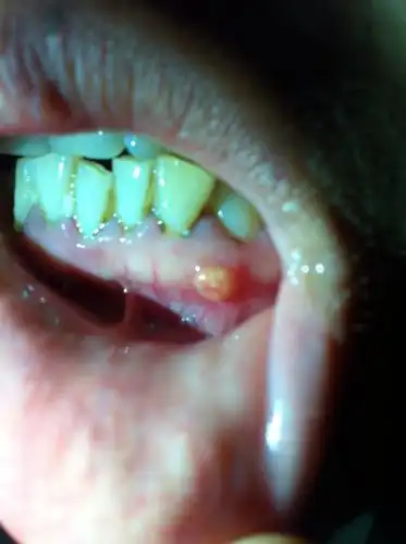 牙龈下面有个泡,里面充满了血,弄破血放掉又起来了,不痛,只要吃辣椒就