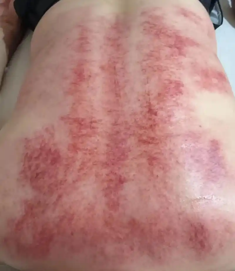 中太镇足玉堂.①[烟花][烟花]特惠39元(刮痧 拔罐 ②[ - 抖音