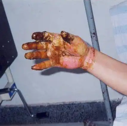 烧伤怎么处理烧伤怎么处理最好2022已更新今日图集