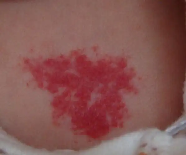 宝宝出生后 胸口有一块红色的东西 不知是什么