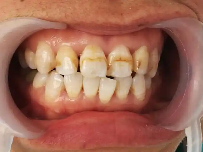 阳城二院朝阳口腔氟斑牙美白一例