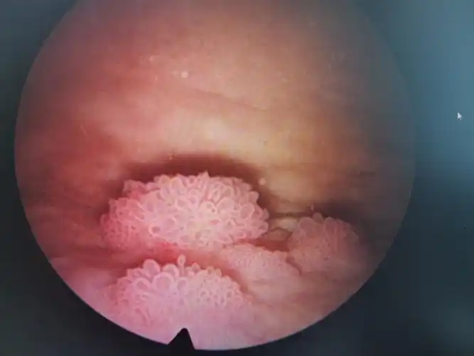 膀胱癌 - 好大夫在线