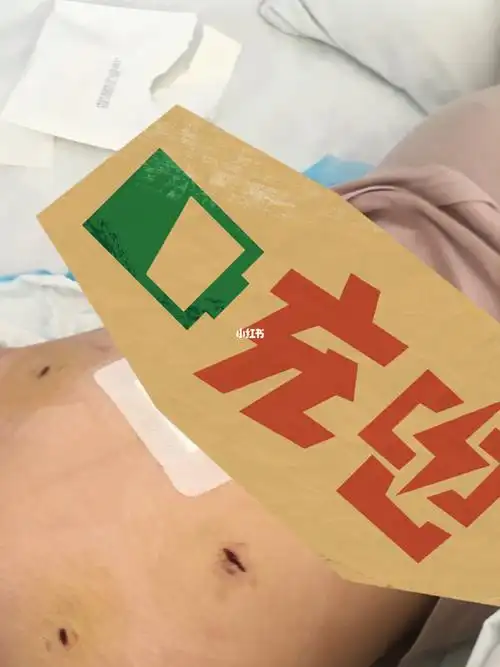 宫外孕腹腔镜术后第四天