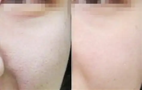 光子嫩肤治疗前后对比图