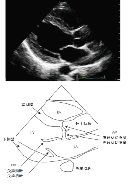 4声窗7切面搞定急诊超声心动图:由浅入深学tte|急诊"心"事