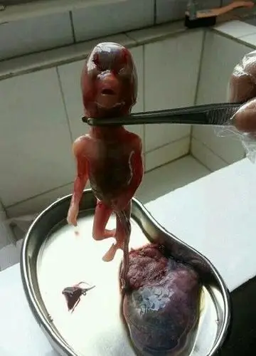 血淋漓的堕胎照片 看了你还忍心堕胎吗?_亲子频道_凤凰网