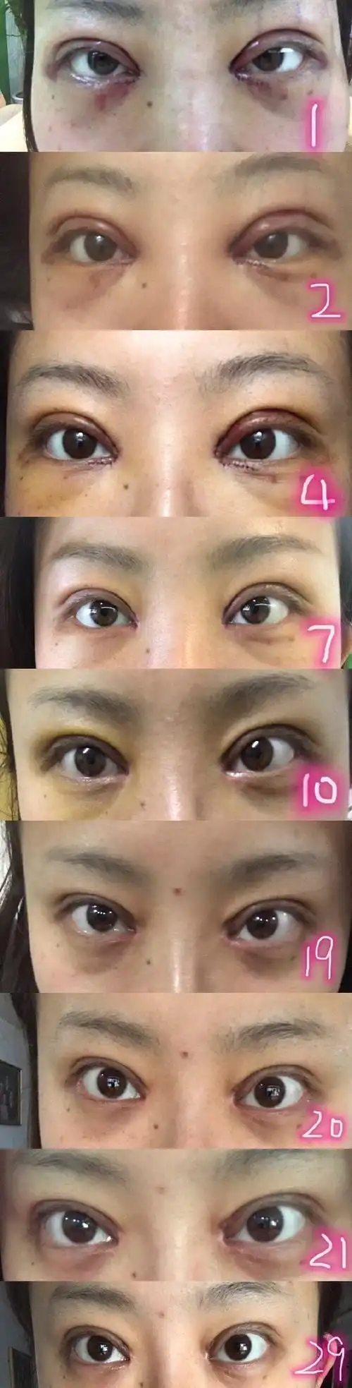 全切双眼皮 开内眼角,术后4个月.