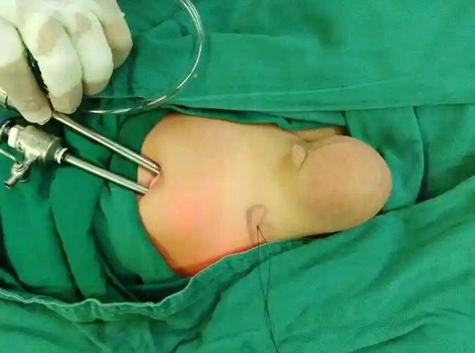 自肚脐入路腹腔镜儿童疝手术的优势_腹股沟疝