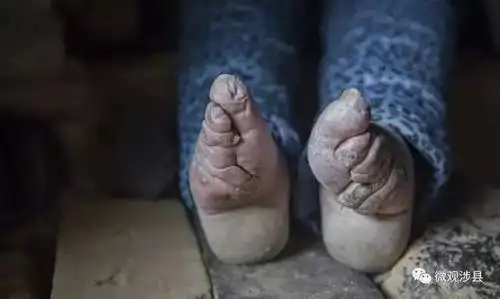 用长白布将双脚紧紧缠裹,昼夜不松,使脚骨变成畸形,从而成为小脚女人
