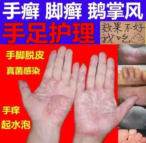 治手癣膏手气膏脚手足癣藓手痒水泡脱皮干裂鹅掌风真菌感染的药膏畜牧