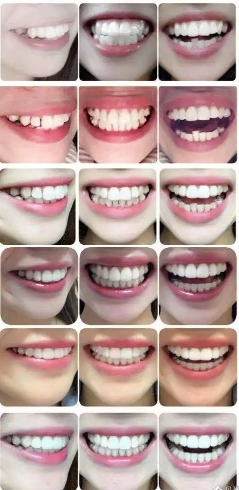 牙齿矫正几大方法,总有一种适合你