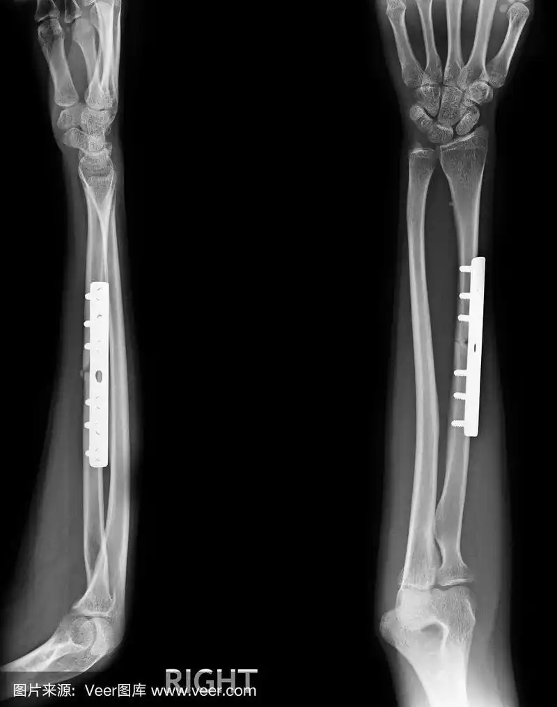 桡骨尺骨骨折,x线片