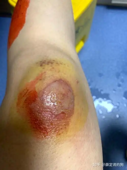 骑车摔倒后擦伤伤口的湿性愈合