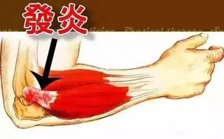 神经肽的发现表明神经性炎症可能是患者出现肘关节外侧疼痛的原因之一
