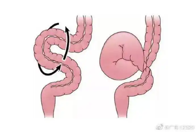 肠扭转是肠子"打了个结"?