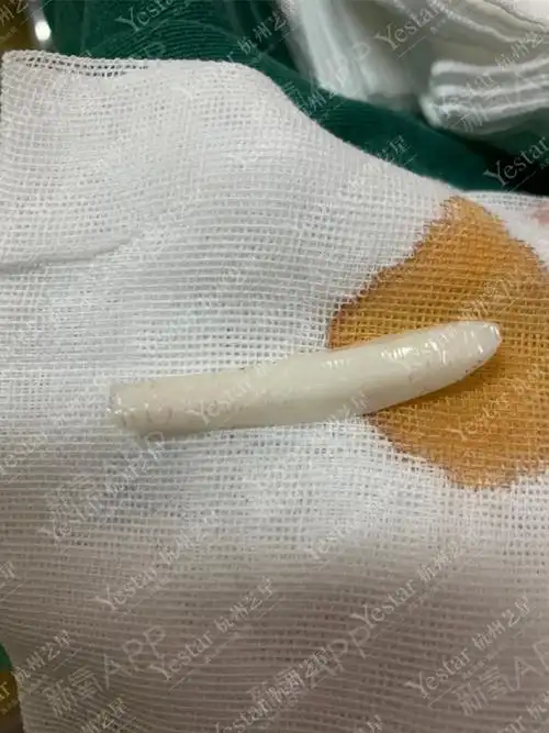 硅胶相比膨体无压缩率,以及取出难度也会小一点,但是容易产生包膜以及