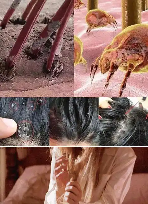 头皮总痒头屑多试试它疯扫头皮屑一丝不留