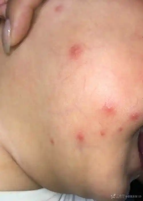8月婴幼儿头面部散在红色斑丘疹