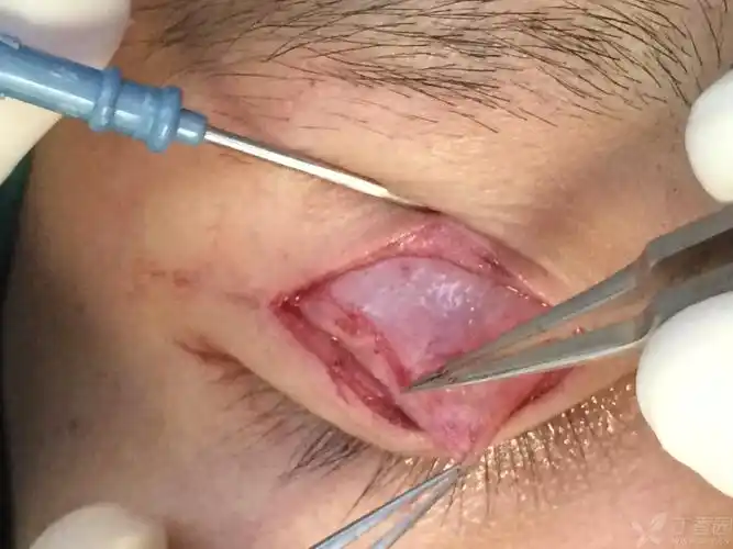 【讨论】单纯上睑提肌腱膜缩短矫正上睑下垂 [病例帖]