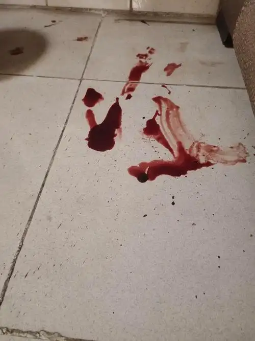 【讨论】后续 外伤有图慎入 一觉醒醒来 楼梯地板有血