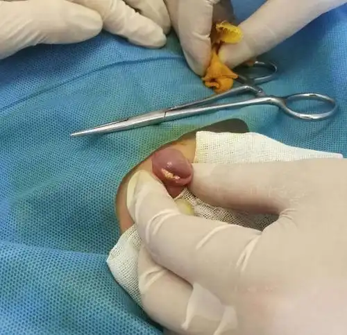 新桥医院陈医生给您讲解包皮过长,包茎及包皮环切术_包皮过长_手术