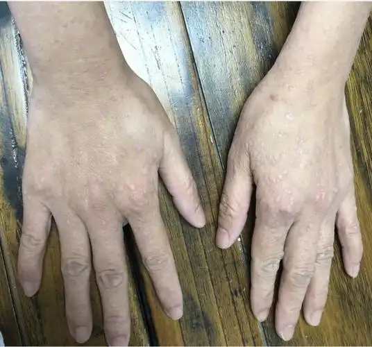 身上有这4种肉疙瘩可能与hpv感染有关