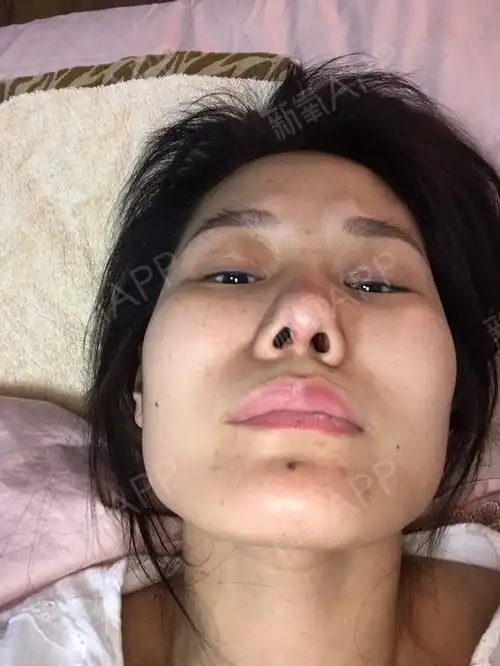 鼻子取假体后严重增生,已经五个月了,希望医生能帮我_圈子-新氧美容