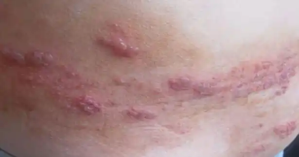 男性淋病图片图_有来医生