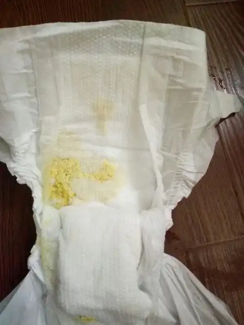 宝宝拉的便便淡黄色,像蒸的鸡蛋一样,什么原因?