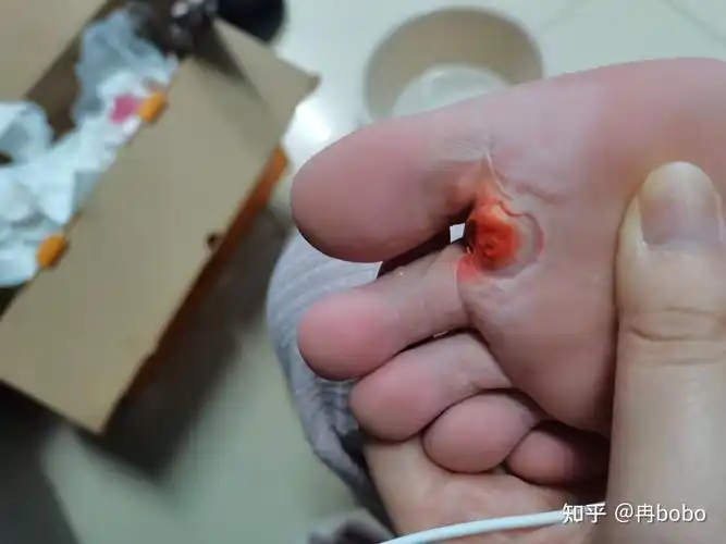 室友挖鸡眼是一种怎样的体验? - 知乎