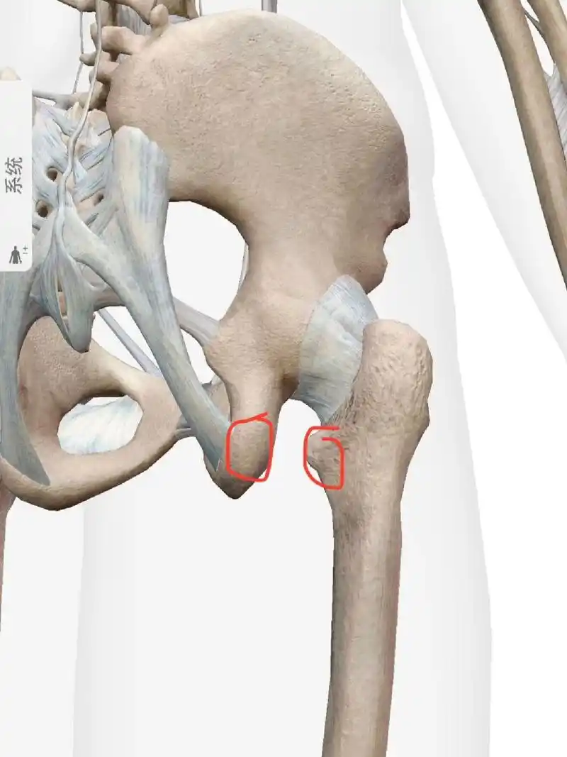髋撞康复 底层逻辑分析 (3) 第三种(ifi)就是坐骨股骨撞击, 害怕大