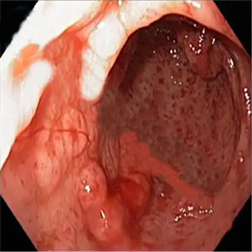 南区胃炎医院_南区治疗胃炎哪家医院好_南区治疗胃炎权威的医院/排行