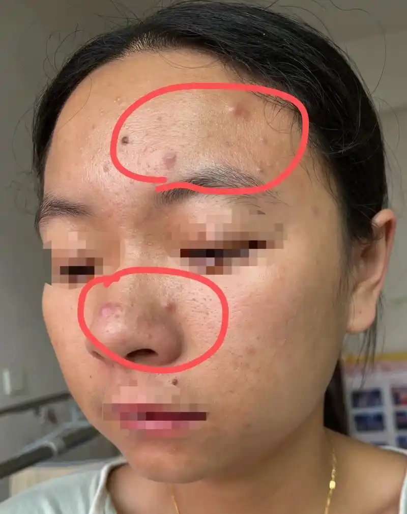 遗传性红肿大痘痘.同款痘肌可以抄作业哦 『1v1 跟踪95』 - 抖音