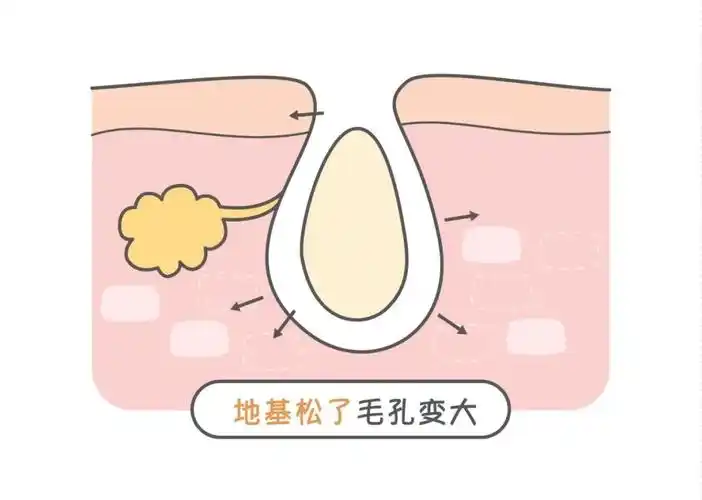 毛孔粗大如何用医美来解决