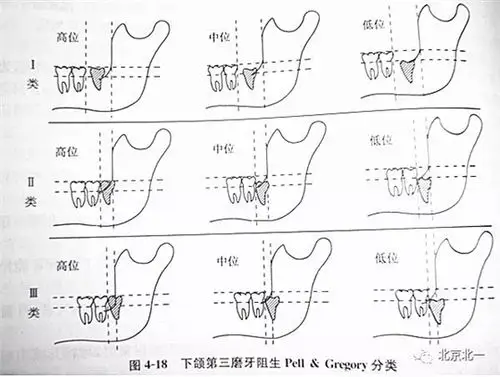 阻生牙(下颌第三磨牙)的分类