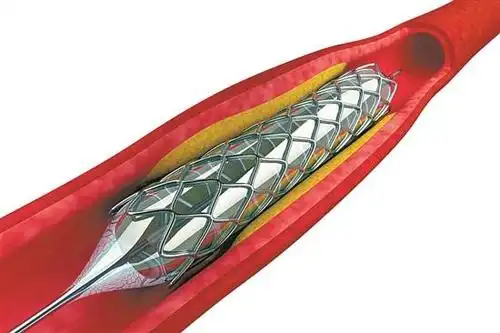 血管造影及支架植入手术室