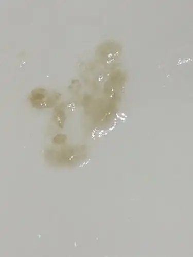 咳出来的痰是这样的,出什么问题了?